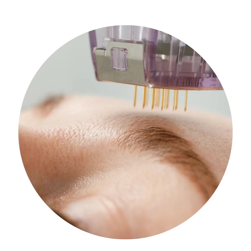 Microneedling